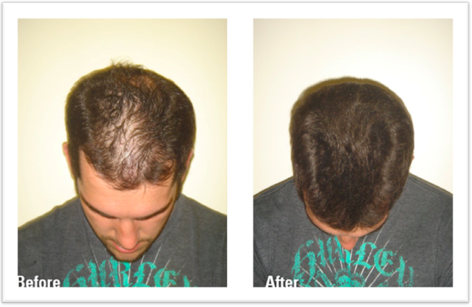 stages of hair loss - Steve Hightower Hair Salon & Day Spa in Atlanta, GA